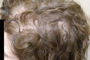laser-therapy-before-and-after-patient-16-a laser-therapy-before-and-after-patient-16-a