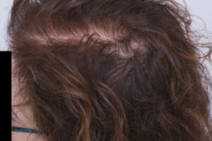 laser-therapy-before-and-after-patient-16-b laser-therapy-before-and-after-patient-16-b