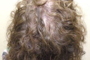 laser-therapy-before-and-after-patient-16-c laser-therapy-before-and-after-patient-16-c