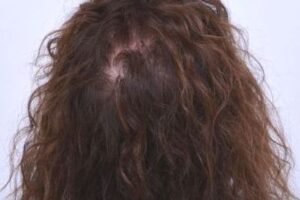 laser-therapy-before-and-after-patient-16-d laser-therapy-before-and-after-patient-16-d