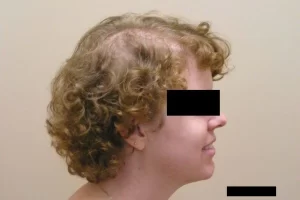 laser-therapy-before-and-after-patient-2-a laser-therapy-before-and-after-patient-2-a