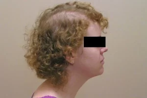 laser-therapy-before-and-after-patient-2-b laser-therapy-before-and-after-patient-2-b