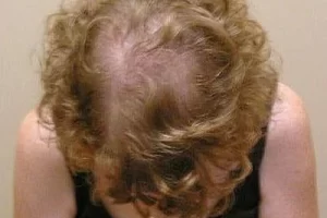laser-therapy-before-and-after-patient-2-c laser-therapy-before-and-after-patient-2-c