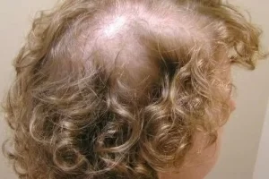 laser-therapy-before-and-after-patient-2-e laser-therapy-before-and-after-patient-2-e