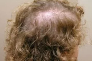 laser-therapy-before-and-after-patient-2-f laser-therapy-before-and-after-patient-2-f
