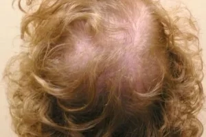 laser-therapy-before-and-after-patient-2-g laser-therapy-before-and-after-patient-2-g