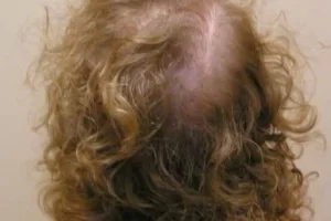 laser-therapy-before-and-after-patient-2-h laser-therapy-before-and-after-patient-2-h