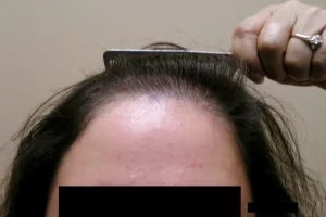 laser-therapy-before-and-after-patient-3-a laser-therapy-before-and-after-patient-3-a
