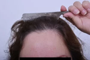 laser-therapy-before-and-after-patient-3-b laser-therapy-before-and-after-patient-3-b