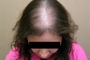 laser-therapy-before-and-after-patient-3-c laser-therapy-before-and-after-patient-3-c