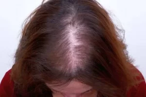 laser-therapy-before-and-after-patient-3-d laser-therapy-before-and-after-patient-3-d