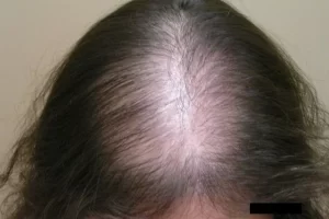 laser-therapy-before-and-after-patient-3-e laser-therapy-before-and-after-patient-3-e