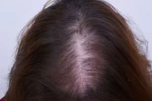 laser-therapy-before-and-after-patient-3-f laser-therapy-before-and-after-patient-3-f