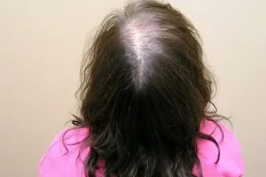 laser-therapy-before-and-after-patient-3-g laser-therapy-before-and-after-patient-3-g