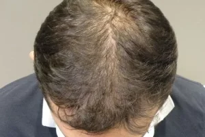 laser-therapy-before-and-after-patient-4-c laser-therapy-before-and-after-patient-4-c