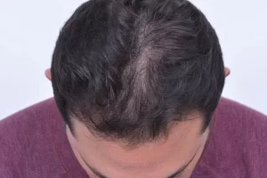laser-therapy-before-and-after-patient-4-d laser-therapy-before-and-after-patient-4-d