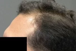 laser-therapy-before-and-after-patient-4-e laser-therapy-before-and-after-patient-4-e