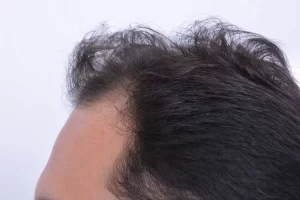 laser-therapy-before-and-after-patient-4-f laser-therapy-before-and-after-patient-4-f