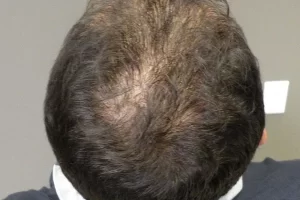 laser-therapy-before-and-after-patient-4-g laser-therapy-before-and-after-patient-4-g