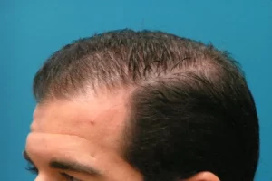 laser-therapy-before-and-after-patient-5-a laser-therapy-before-and-after-patient-5-a