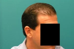 laser-therapy-before-and-after-patient-5-c laser-therapy-before-and-after-patient-5-c