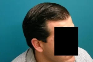 laser-therapy-before-and-after-patient-5-d laser-therapy-before-and-after-patient-5-d