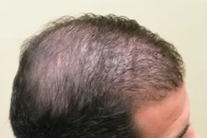 laser-therapy-before-and-after-patient-5-e laser-therapy-before-and-after-patient-5-e