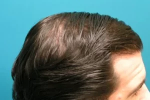 laser-therapy-before-and-after-patient-5-f laser-therapy-before-and-after-patient-5-f