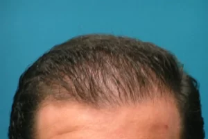 laser-therapy-before-and-after-patient-5-g laser-therapy-before-and-after-patient-5-g