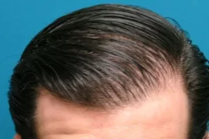 laser-therapy-before-and-after-patient-5-h laser-therapy-before-and-after-patient-5-h