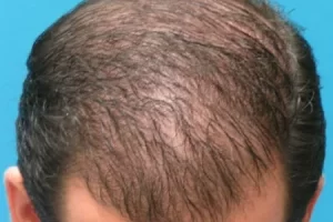 laser-therapy-before-and-after-patient-5-i laser-therapy-before-and-after-patient-5-i