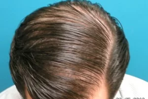 laser-therapy-before-and-after-patient-5-j laser-therapy-before-and-after-patient-5-j
