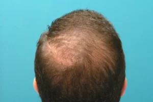 laser-therapy-before-and-after-patient-5-k laser-therapy-before-and-after-patient-5-k