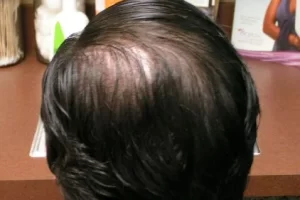 laser-therapy-before-and-after-patient-5-l laser-therapy-before-and-after-patient-5-l