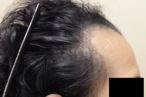 laser-therapy-before-and-after-patient-6-a laser-therapy-before-and-after-patient-6-a