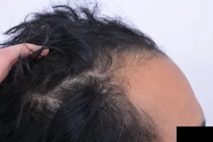laser-therapy-before-and-after-patient-6-b laser-therapy-before-and-after-patient-6-b