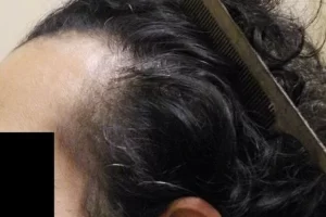 laser-therapy-before-and-after-patient-6-c laser-therapy-before-and-after-patient-6-c