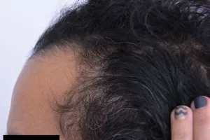 laser-therapy-before-and-after-patient-6-d laser-therapy-before-and-after-patient-6-d