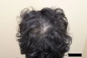 laser-therapy-before-and-after-patient-6-e laser-therapy-before-and-after-patient-6-e
