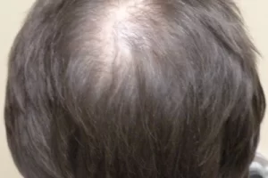 laser-therapy-before-and-after-patient-7-a laser-therapy-before-and-after-patient-7-a
