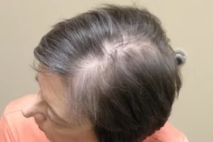 laser-therapy-before-and-after-patient-7-c laser-therapy-before-and-after-patient-7-c