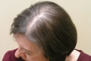 laser-therapy-before-and-after-patient-7-d laser-therapy-before-and-after-patient-7-d
