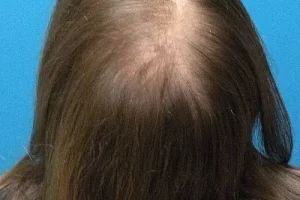 laser-therapy-before-and-after-patient-8-a laser-therapy-before-and-after-patient-8-a