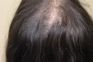 laser-therapy-before-and-after-patient-8-b laser-therapy-before-and-after-patient-8-b