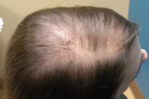 laser-therapy-before-and-after-patient-8-c laser-therapy-before-and-after-patient-8-c