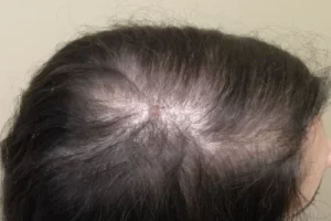 laser-therapy-before-and-after-patient-8-d laser-therapy-before-and-after-patient-8-d
