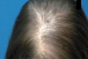 laser-therapy-before-and-after-patient-8-e laser-therapy-before-and-after-patient-8-e
