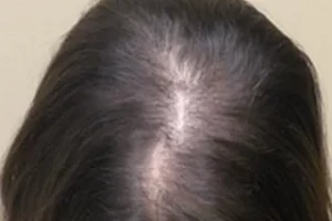 laser-therapy-before-and-after-patient-8-f laser-therapy-before-and-after-patient-8-f