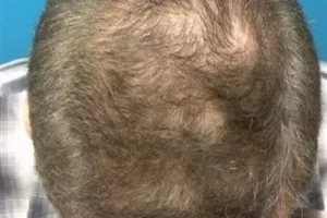 laser-therapy-before-and-after-patient-9-a laser-therapy-before-and-after-patient-9-a