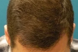 laser-therapy-before-and-after-patient-9-b laser-therapy-before-and-after-patient-9-b